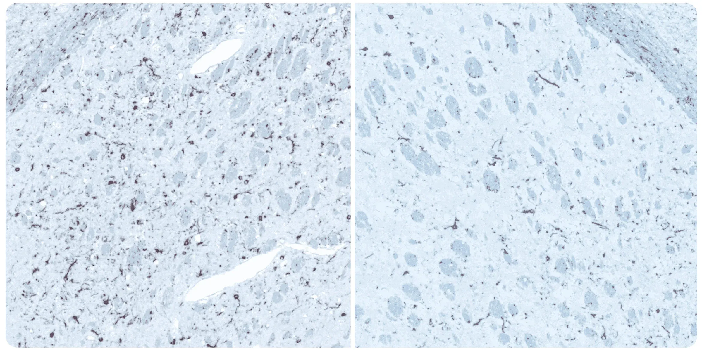 Coloration immunohistochimique (IHC) de coupes de tissus cérébraux pour révéler la charge en alpha synucléine dans le noyau olfactif antérieur (AON), associée à la maladie de Parkinson (PD)