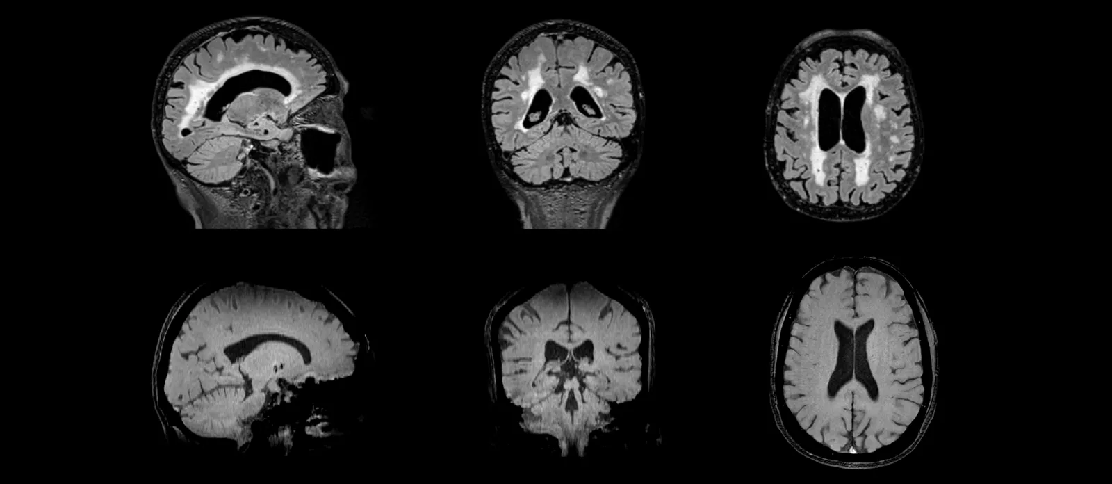 MR Images of human brain for evaluation of Amyloid-Related Imaging Abnormalities (ARIA)