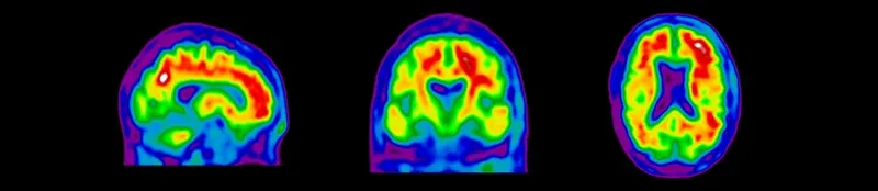 Différentes vues d'images TEP de l'amyloïde pour l'évaluation de l'éligibilité des sujets aux essais cliniques sur la maladie d'Alzheimer.
