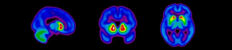 Différentes vues de scanners d'imagerie dopaminergique pour l'évaluation de l'éligibilité des sujets aux essais cliniques sur la maladie de Parkinson.