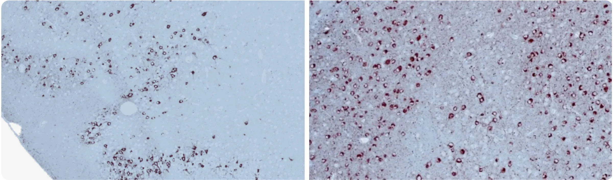 Deux coupes de tissu cérébral colorées pour révéler la protéine tau, associée à la maladie d'Alzheimer (MA), mettant en évidence les différences d'accumulation de tau dans l'hippocampe (HC) et le cortex (Ctx).