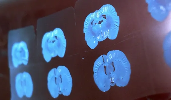 Une série de scanners cérébraux IRM (imagerie par résonance magnétique) affichés sur un caisson lumineux ou un écran numérique.