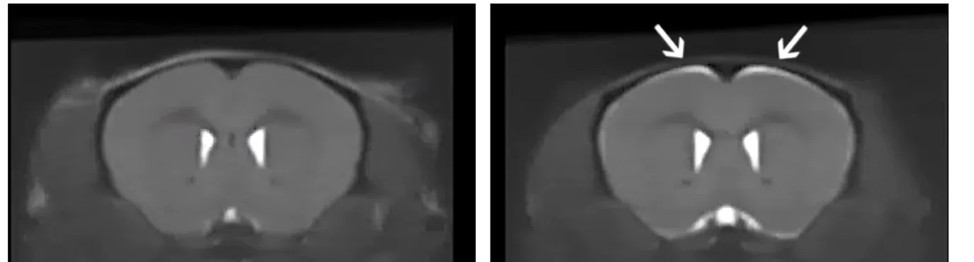 Two MRI images with one showing bright CSF