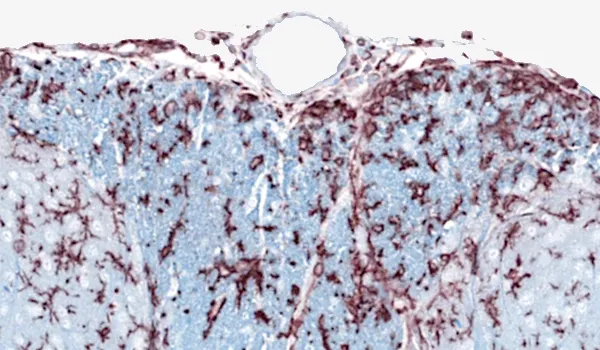 Sclérose en plaques - coupe histologique d'un tissu neural coloré pour montrer les détails cellulaires et structurels.