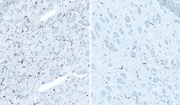 Immunohistochemistry (IHC) staining of brain tissue sections to reveal alpha synuclein burden in anterior olfactory nucleus (AON), associated with Parkinson's Disease (PD)