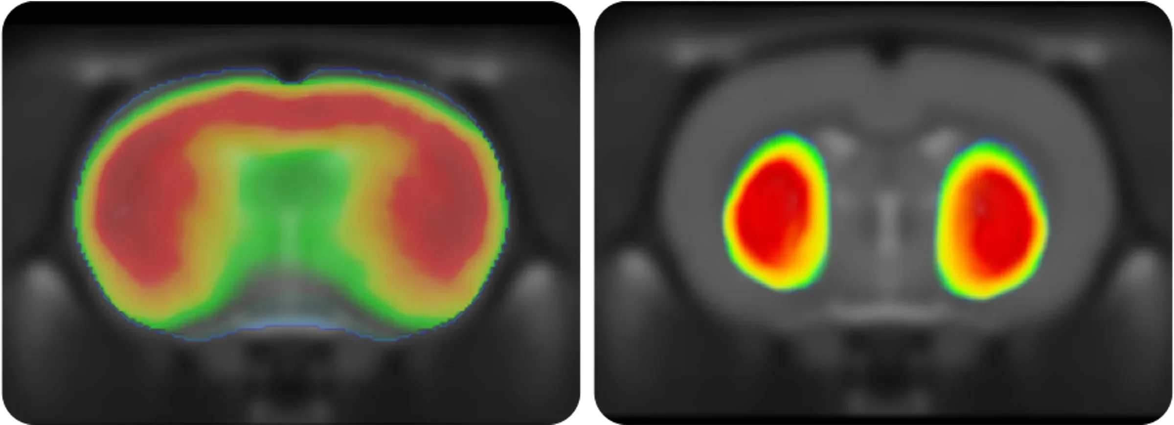Deux petits panneaux carrés représentant chacun ce qui semble être une tomographie par émission de positrons (TEP), un type d'examen d'imagerie qui aide à révéler le fonctionnement des tissus et des organes.