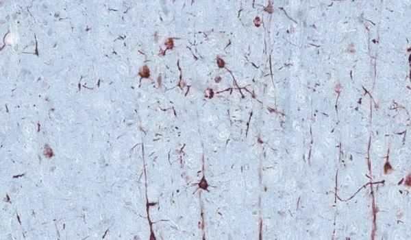 Parkinson's Disease - IHC staining