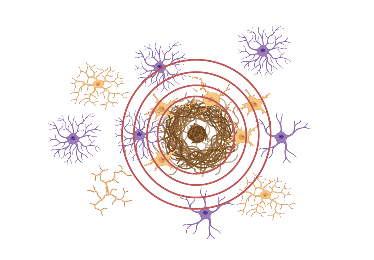 Une plaque amyloïde, c'est-à-dire un ensemble de fragments de protéines qui s'accumulent entre les neurones. Les cercles concentriques peuvent symboliser la zone d'influence ou la propagation de l'impact de la plaque sur le tissu cérébral environnant.